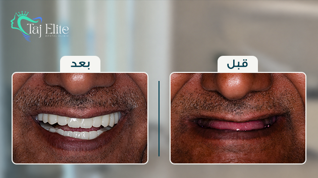 before-^-after2